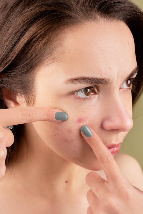 Adult Acne: Beyond the Basics – How to Reclaim Your Clear Skin